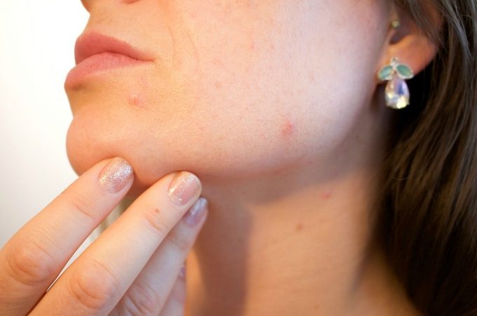 4 great ways to treat adult acne