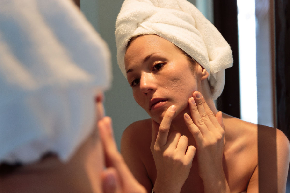 woman with acne scars and hair wrapped in towel